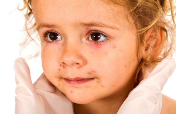 Ветряная оспа на глазах у ребенка и взрослого: особенности лечения