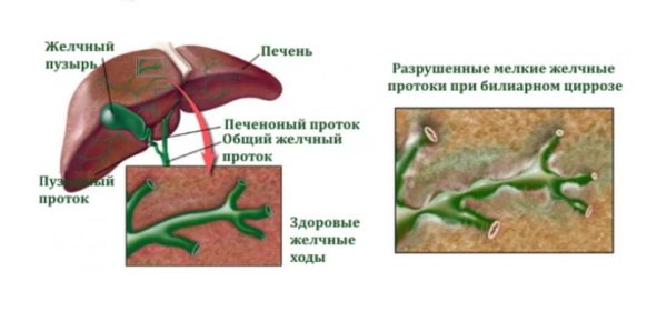 Зуд кожи тела при заболеваниях печени: причины, симптомы, лечение 3