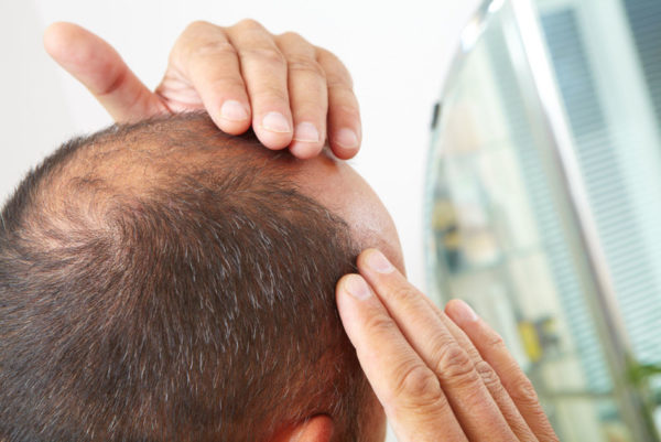 Какое средство от облысения по мужскому типу помогает от выпадения волос и облысения