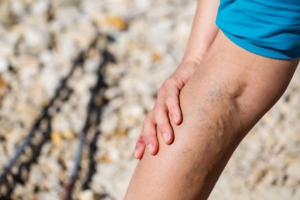 Трофическая язва на ноге: лечение мазями и как ими пользоваться 1