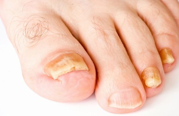 Грибок ногтей на большом пальце ноги: лечение народными средствами и противогрибковыми препаратами1
