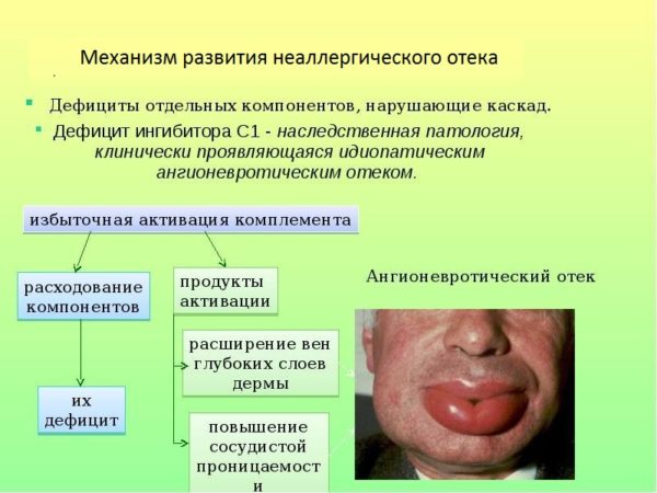 Отек Квинке: симптомы, опаснейшая локализация отека Квинке, лечение болезни 2