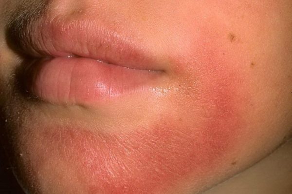 Как средство от кожной аллергии можно использовать мазь для быстрого снятия раздражения и зуда