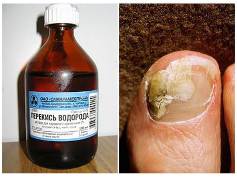 Доктор Неумывакин: Лечение грибка ногтей перекисью водорода2