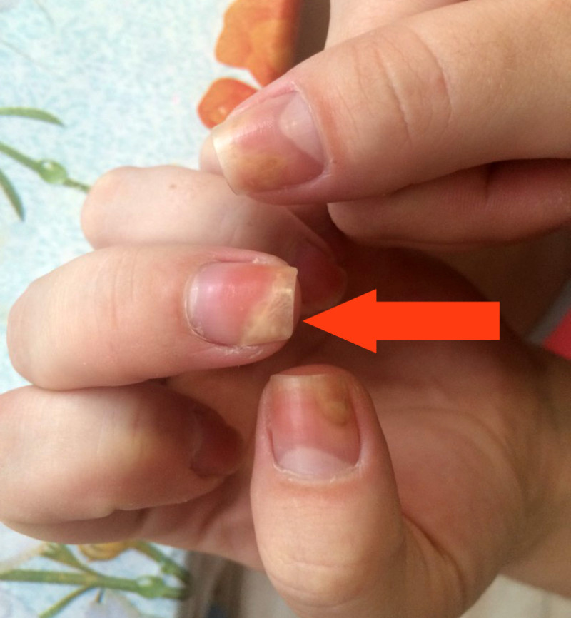 Ноготь отходит от ногтевого ложа руки: лечение различных видов расслоения