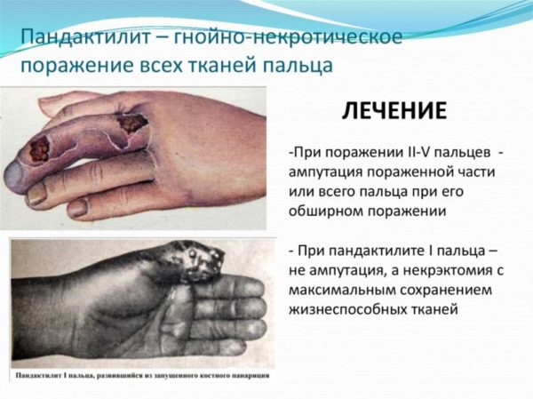 Панариций пальца на руке: лечение, хирургическое удаление, домашние препараты 6