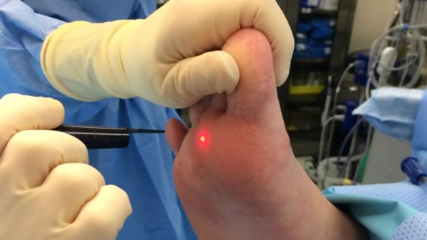 Бородавка на пальце ноги: как она выглядит и какие методы лечения существуют 5