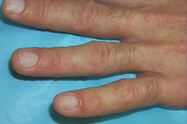 Дисгидроз кистей рук: лечение, симптомы, причины появления 0