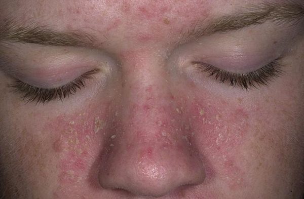 Себорейный дерматит на лице: лечение, признаки, причины развития, диетотерапия 2