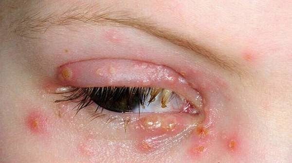 Ветряная оспа на глазах у ребенка и взрослого: особенности лечения 1