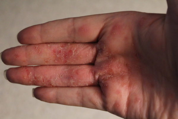 Дисгидроз кистей рук: лечение, симптомы, причины 3
