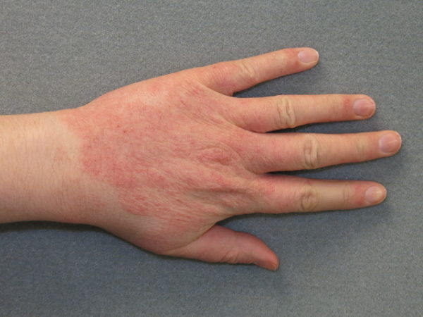 Аллергия на коже: виды, причины, проявления, лечение заболевания 2