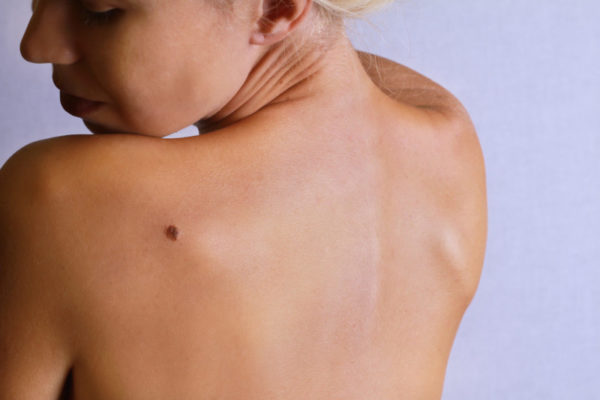 Бородавки на спине: причины их появления и способы удаления