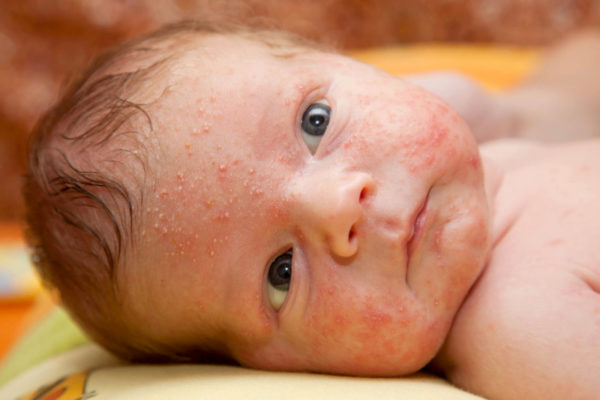 Острая жара на лице у детей: симптомы, лечение, профилактика