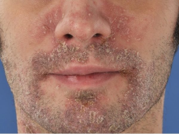 Себорейный дерматит на лице: лечение, признаки, причины развития, диетотерапия 3