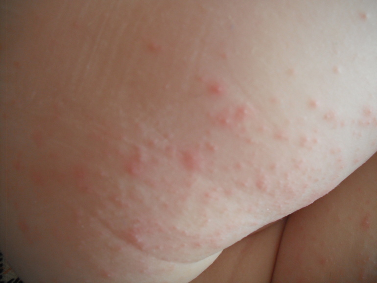 Прыщи на теле ребенка чешутся и выглядят как укус комара: причины, как избавиться от симптомов