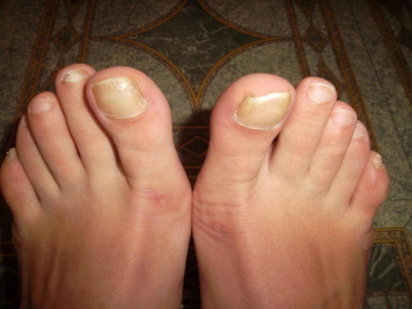Грибок ногтей на большом пальце ноги: лечение народными средствами и противогрибковыми препаратами