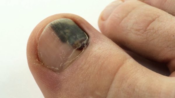Черное пятно на ногте большого пальца ноги: причины появления, методы устранения проблемы