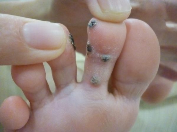 Бородавка на пальце ноги: как она выглядит и какие методы лечения есть