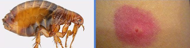 Прыщи на теле ребенка чешутся и выглядят как укус комара: причины, как избавиться от симптомов