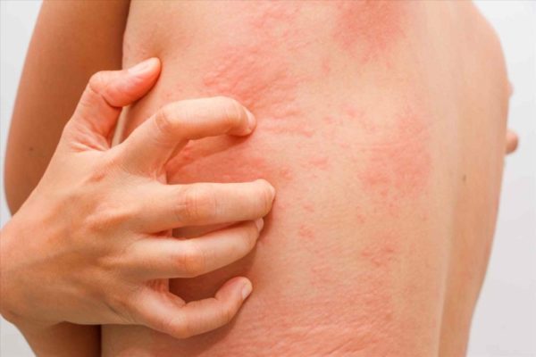 Аллергия на коже: виды, причины, проявления, лечение заболевания0