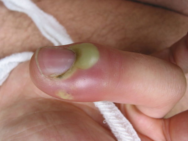 Панариций пальца: лечение хирургическим удалением, домашние препараты 5