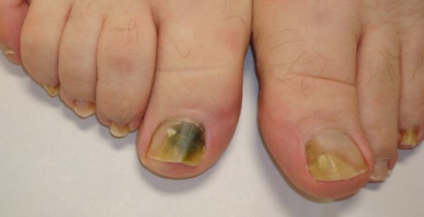 Черное пятно на ногте большого пальца ноги: причины появления, методы устранения проблемы