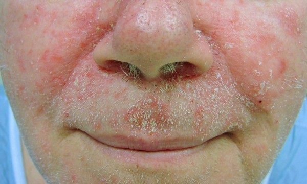 Себорейный дерматит на лице: лечение, признаки, причины развития, диетотерапия