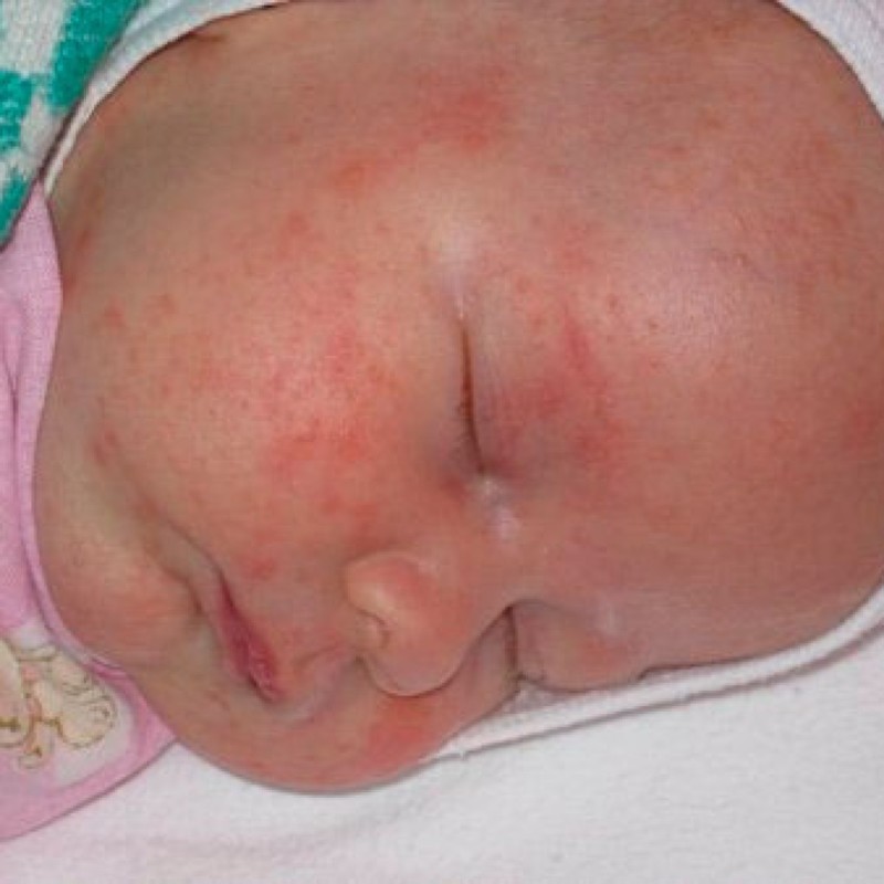 Как отличить потницу от аллергии у грудничков (новорожденных): основные отличия