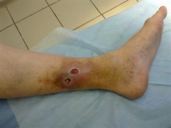 Трофическая язва на ноге: лечение мазями и как ими пользоваться
