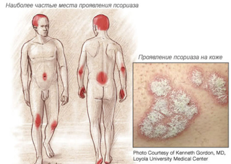 Склеротический лишай (лишай) Цумбуша у мужчин и женщин в интимной зоне: признаки и лечение заболевания3