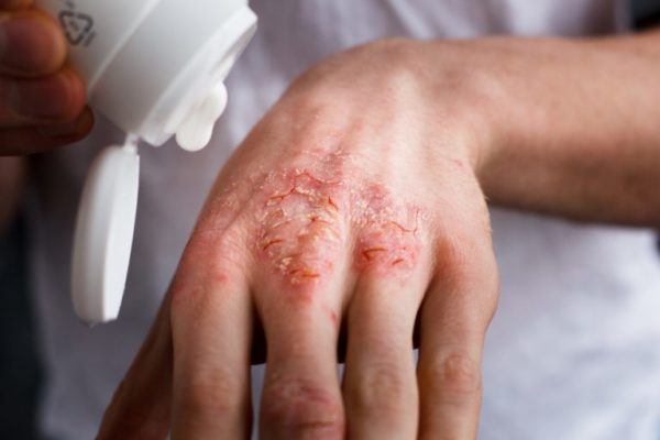 Аллергия на коже: виды, причины, проявления, лечение заболевания 3