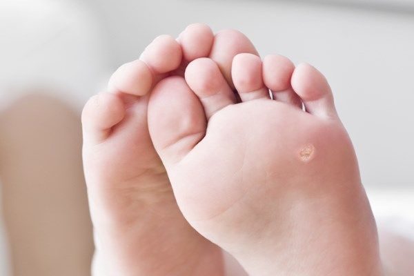 Подошвенная бородавка на ноге у ребенка: как от нее избавиться и чем лечить