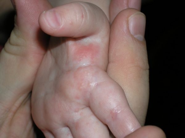 Дисгидроз кистей рук: лечение, симптомы, причины 5