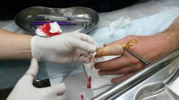 Панариций пальца на руке: лечение, хирургическое удаление, домашние препараты 11