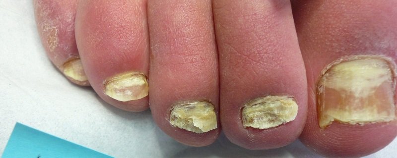 Доктор Неумывакин: Лечение грибка ногтей перекисью водорода