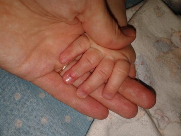 Панариций пальца на руке: хирургическое удаление, домашние препараты 7