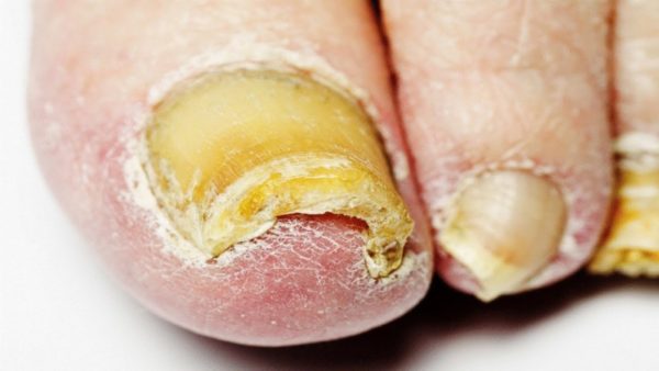 Расширенное лечение грибка ногтей: народные методы терапии, медикаментозное лечение