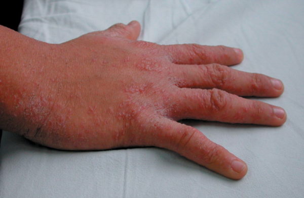 Зудящие руки: причины покраснения и шелушения и как лечить в домашних условиях