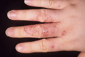 Лечение грибка рук: признаки и симптомы кожных заболеваний, методы лечения