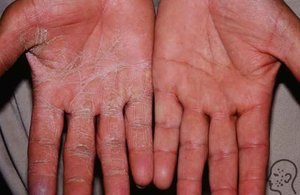 Лечение грибка рук: признаки и симптомы кожных заболеваний, методы лечения 6