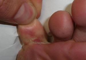 Грибок между пальцами: симптомы и признаки, лечение препаратами и народными средствами