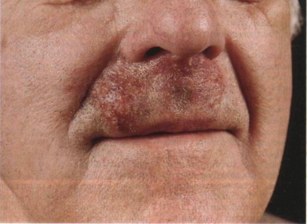 Сикоз носа: лечение мазями, симптомы заболевания 2