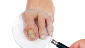 Лечение грибка ногтей флуконазолом: инструкция по применению и отзывы