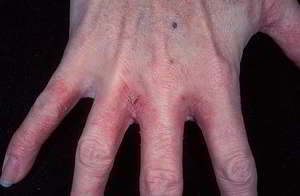 Лечение грибка рук: признаки и симптомы кожных заболеваний, методы лечения 3