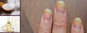 Средство от грибка ногтей на руках: эффективные противогрибковые таблетки и капли, мази и кремы6