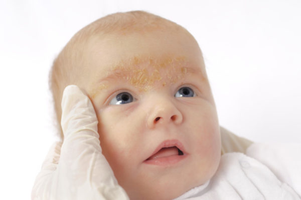 Себорейный дерматит у детей: причины, симптомы, терапия 4