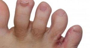Грибок между пальцами: симптомы и признаки, лечение препаратами и народными средствами9