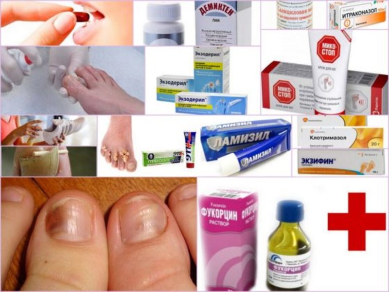 Противогрибковые препараты для ногтей на ногах: виды препаратов и эффективность при лечении грибков