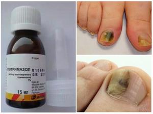 Клотримазол: применение мази от грибка на ногтях и стопах, отзывы о лечении